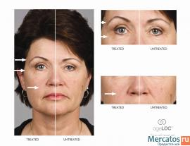 Аппаратная косметология на дому. NU SKIN 5