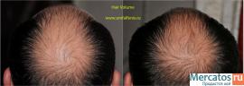 трикоксен устарел. NEW средство против выпадение волос Hairvolum 2