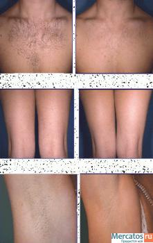 удаление волос (воскоэпиляция, фотоэпиляция) только для женщин